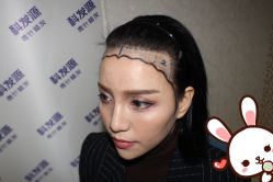 点击看大图 -大麦微针植发丨全国连锁