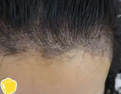 -大麦微针植发丨全国连锁