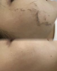 -薇兰专业脱毛连锁机构