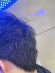 -碧莲盛·不剃发植发