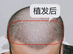 -大麦微针植发全国连锁