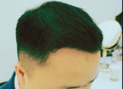 -大麦微针植发丨全国连锁