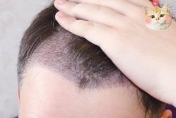 -大麦微针植发丨全国连锁