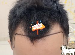 -大麦微针植发全国连锁