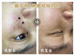 -美人痣全国连锁