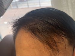 -碧莲盛·不剃发植发