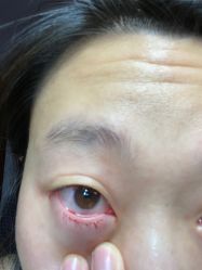 体验后-南京健丽·去眼袋医疗美容机构