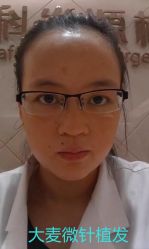 点击看大图 -大麦微针植发丨全国连锁