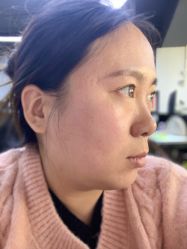 体验后-亿美医疗美容·半岛大超炮官方授权店