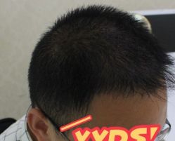 -大麦微针植发丨全国连锁