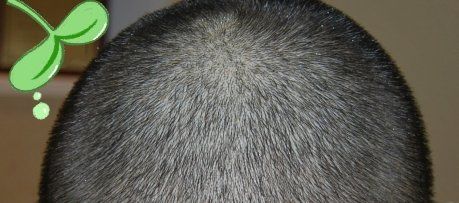 -大麦微针植发丨全国连锁