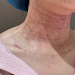 体验后-深圳米兰柏羽医疗美容医院