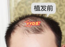 -大麦微针植发全国连锁