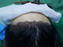 -大麦微针植发丨全国连锁