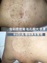 -美肤盾祛痘·问题肌头疗管理中心