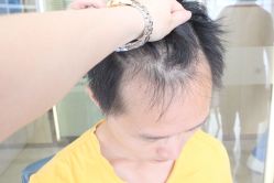 点击看大图 -大麦微针植发丨全国连锁