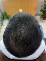 -大麦微针植发全国连锁