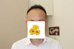 -大麦微针植发丨全国连锁