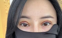 体验后-深圳米兰柏羽医疗美容医院