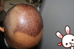 -大麦微针植发丨全国连锁