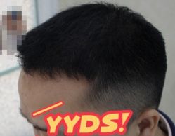 -大麦微针植发丨全国连锁