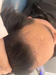 -大麦微针植发全国连锁