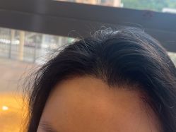 -碧莲盛·不剃发植发