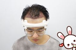 点击看大图 -大麦微针植发丨全国连锁