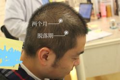 -大麦微针植发全国连锁