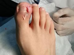 -世龙世家灰指甲鸡眼脚气甲沟炎跖疣护理(通州店)