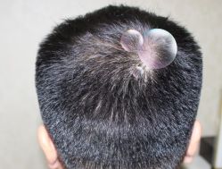 -大麦微针植发丨全国连锁