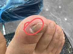 -派恩宜灰指甲甲沟炎(昌安总店)