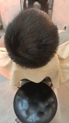 -大麦微针植发丨全国连锁