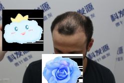 -大麦微针植发丨全国连锁