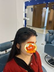 体验后-大麦微针植发全国连锁