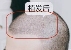 -大麦微针植发全国连锁