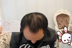 -大麦微针植发丨全国连锁