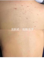 -美肤盾祛痘·问题肌头疗管理中心
