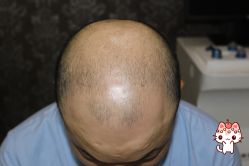 -大麦微针植发丨全国连锁