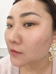 体验后-More摩尔医美の注射线雕光电中心