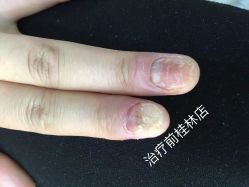 -德哥灰指甲脚气甲沟炎跖疣护理
