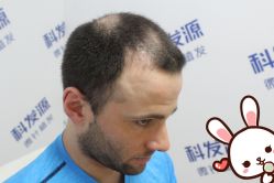 -大麦微针植发丨全国连锁