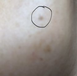 体验前-爱莎扁平疣·汗管瘤·斑痣中心