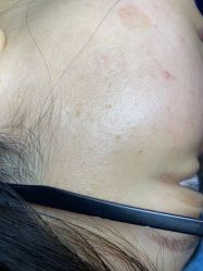 体验前-爱莎扁平疣·汗管瘤·斑痣中心