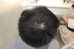 点击看大图 -大麦微针植发丨全国连锁