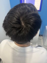 -大麦微针植发全国连锁