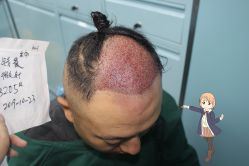 -大麦微针植发丨全国连锁