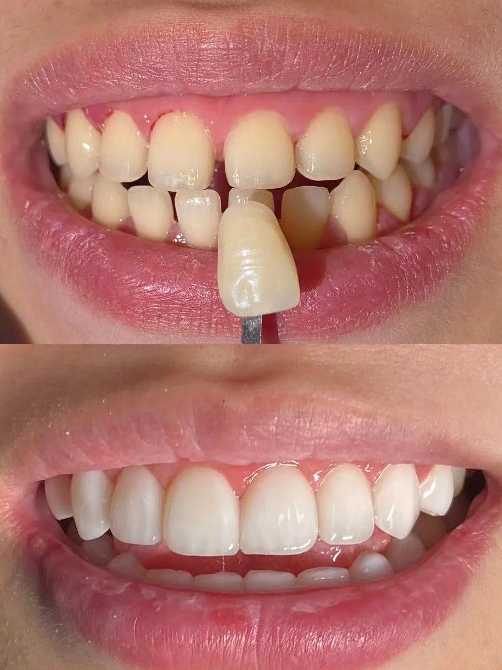 牙缝大不想矫正怎么办