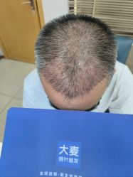 点击看大图 -大麦微针植发丨全国连锁
