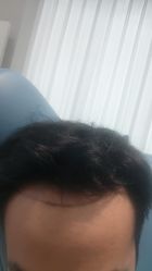 -碧莲盛·不剃发植发